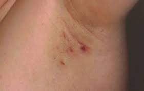 Pin On Armpit