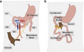 Image result for Intestinal Malrotation