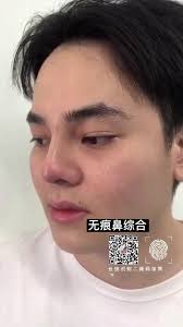无痕鼻综合💉, 无需手术👍🏻, 男士们都很爱美📲, WeChatID：Christallaw0123/0177677335📲