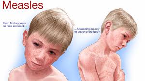 Illnesses, Virus & Pandemics