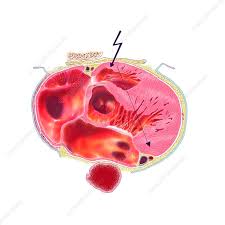 Image result for Extrasystole