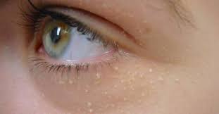 Vous Avez Des Petits Boutons De Milium Sur Le Visage Voici Quoi Faire Pour Vous En Debarrasser Point Blanc Visage Visage Boule De Graisse Visage