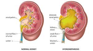 Sistem urinaria adalah sistem organ yang berfungsi untuk menyaring dan membuang zat limbah. Penyakit Hidronefrosis Gejala Penyebab Pengobatan Klikdokter Com