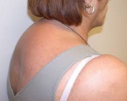 Next, looking at the spine, if the upper back humps up slightly more than spinous sticks out more. Buffalo Hump In Hiv Patients Surgical Management With Liposuction Journal Of Plastic Reconstructive Aesthetic Surgery