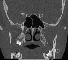 Coronal scan of ostiomeatal unit. Haller Cell Radiology Case Radiopaedia Org