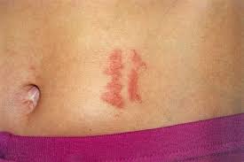 Image result for dermatitis contacta children