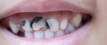 ماذا تعرف عن تسوس الأسنان الأمامية ويب طب