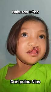 Upaya Perbaikan Bibir Sumbing Anak di Nias