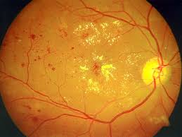 Marc returned to salem to join medical center eye clinic in 2006. Retina Vitreous Aravind Eye Care System
