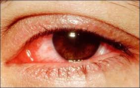 Obat sakit mata digunakan untuk mengobati penyakit atau gangguan pada mata. Sakit Mata Berjangkit Melalui Pandangan Mata Ini Penerangan Dari Doktor
