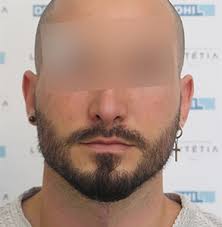Once the surgeon removes the hair follicles from the donor area, he implants them back into the skin of the beard area so they can harvest and create new growth. Beard Transplant In Dubai Maison Lutetia Festival City