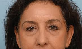 Fat Transfer Before & After Photos