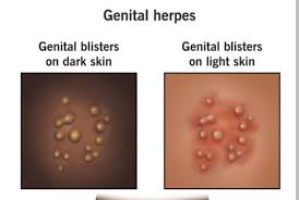 Image result for genital herpes