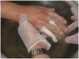 It most often affects the nose, ears, cheeks, chin, fingers, or toes. Expedition Medicine Frostbite In The Wilderness Adventure Medic