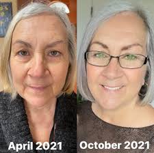 Help Please Oh acne why it so itchy . What are the prevention tips for  acne🥴😵‍💫 Is this part of aging ? I am 42 yrs old and I never experience  this