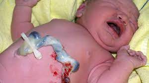 Bei den meisten babys fällt er innerhalb der ersten zehn lebenstage ab. á… Heilungsverlauf Des Nabels Nach Der Geburt Von Der Abnabelung Bis Zur Nabelbildung