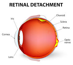 Hilton, east bay retina consultants, inc. Detached Retina Symptoms And Treatment University Health News