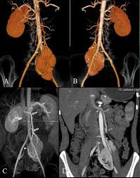 28 Year Old Woman With Duplex Collecting System In A Pelvic Kidney Download Scientific Diagram