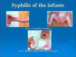 We did not find results for: Tertiary Visceral Syphilis Neurosyphilis Prezentaciya Onlajn