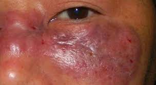 191 resumen abstract la micosis invasiva es una de las mayores causas de morbilidad y invasive fungal infection is one of the major causes of mortalidad en pacientes inmunosuprimidos y críticos. Confirman Dos Primeros Casos De Hongo Negro Por Covid 19 En Paraguay Urgentebo