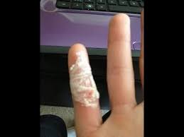 What happens when foot splinters are left untreated? How To Get A Splinter Out An Easy Painless Way To Get A Splinter Out Youtube