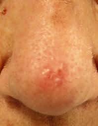 Image result for skin cancer on nose pimple