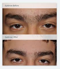 All of the chemical hair removal products have at least the potential of causing a reaction or damaging the skin. Mens Eyebrows Laser Hair Removal Eyebrowshaper