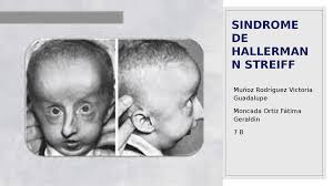 Síndrome de Hallermann-Streiff: Características, Diagnóstico y Tratamiento 