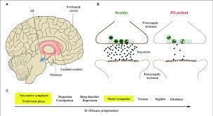 A pilot randomized controlled trial mov disord. Parkinson S Disease Pd Anova Irm Germany