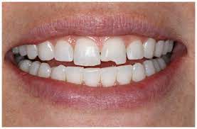 I added a pic here of a tooth i chipped recently. I Ve Chipped My Top Front Tooth How Much Would It Cost To Get It Repaired Photo