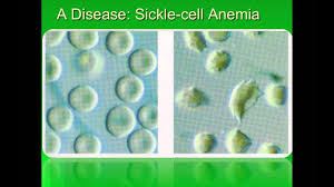 Sickle cell anemia is an autosomal recessive disorder affecting the function of hemoglobin. Gene Mutations And Sickle Cell Anemia Ib Biology Youtube