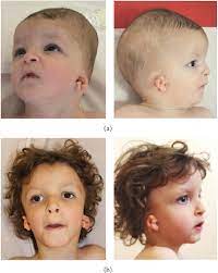 Pdf Severe Psychomotor Delay In A Severe Presentation Of Cat Eye Syndrome Semantic Scholar