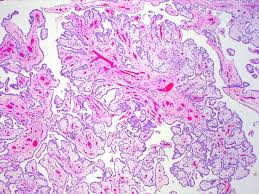 A malignant neoplasm arising from mesothelial cells. Pathology Outlines Peritoneum Well Differentiated Papillary Mesothelioma