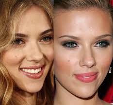 Scarlett Johansson Plastic Surgery Before and After Nose Job and Breast  Implants
