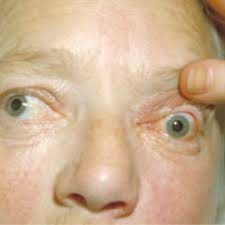 Exophthalmos (also called exophthalmus, exophthalmia, proptosis, or exorbitism) is a bulging of the eye anteriorly out of the orbit. Exophthalmus Doccheck Flexikon