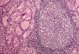 Graves disease is the most common cause of hyperthyroidism and often affects women. Hashimoto Thyroiditis Pathology Student