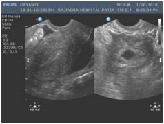Image result for corpus luteum sonography)