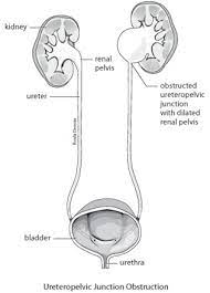 Ureteropelvic Junction Obstruction Surgeon For Dilated Renal Pelvis