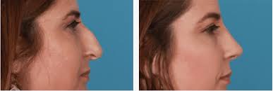 Please look carefully at the postoperative images. Rhinoplasty Nose Job Scotland Nose Reshaping Expression Facial Surgery