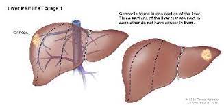 When cancer starts in the liver, it is called liver cancer. Liver Cancer In Children Causes Symptoms Diagnosis And Treatment St Louis Childrens Hospital