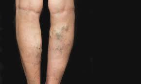 Como Curar Las Varices Con Aceite De Oliva Remedio Muy Efectivo