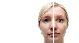 Wrinkle-Reducing Treatments