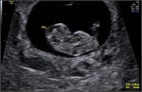 The scan is optional and not everyone will have it. Pregnancy Week 8