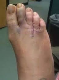 A Basic Guide To Morton S Stump Neuromas Neuroma Surgery Morton S Neuroma Foot Surgery