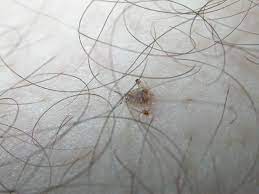 How do you know if you have body lice. What Does Lice Look Like Photos Info On Head Body Pubic Lice Health Com
