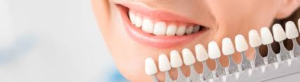 How Often Should I Do Teeth Whitening Smile Makeover Of La