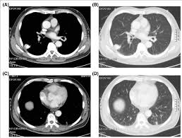Synchronous Multiple Primary Lung Cancer Of The 68 Year Old Patient Download Scientific Diagram