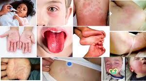 Image result for Multisystem Inflammatory Syndrome