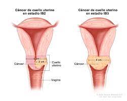 Algunos de los síntomas más comunes son: Tratamiento Del Cancer De Cuello Uterino Pdq Version Para Pacientes Instituto Nacional Del Cancer