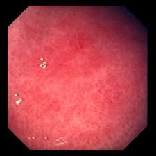 Das krankheitsbild reicht von beschwerdefreiheit (häufig bei der chronischen form) bis hin zur lebensgefährlichen magenblutung mit bluterbrechen (akute form). Gastritis Verdauungsstorungen Msd Manual Ausgabe Fur Patienten
